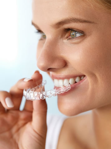 clear aligners